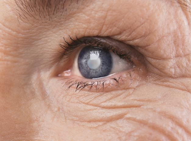 Grauer Star (Katarakt) bigstock-Cataract-Senior-woman-175059043-Yastremska