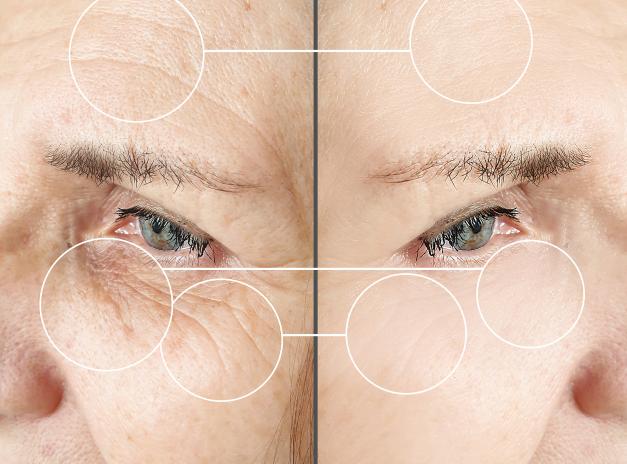 bigstock-Face-Wrinkles-Before-After-407877395-TanyaLovus